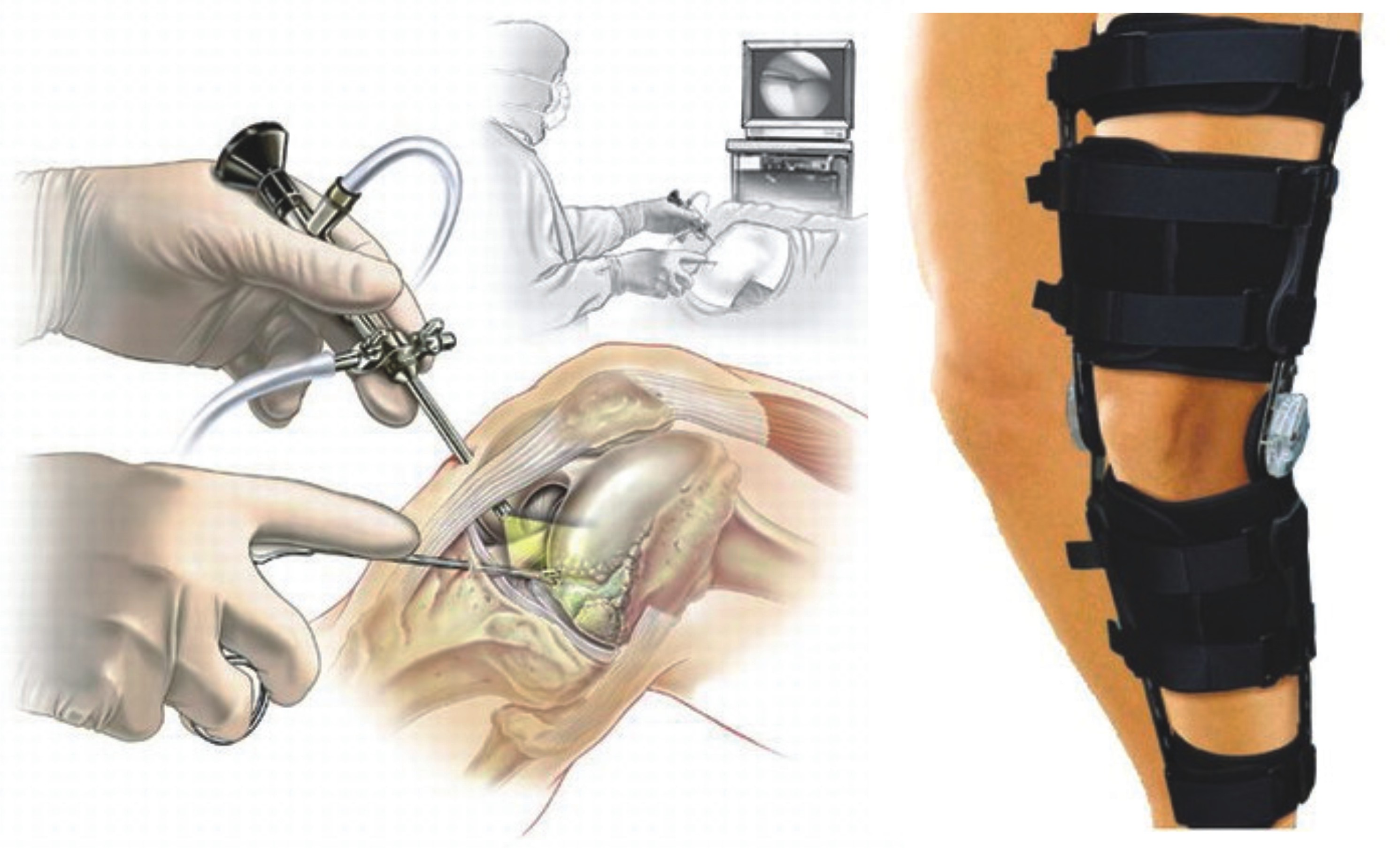 Операция колено пкс. Операция на разрыв мениска артроскопия. Артроскопия ПКС коленного сустава. Операция артроскопия коленного сустава. Разрыв мениска коленного операция.